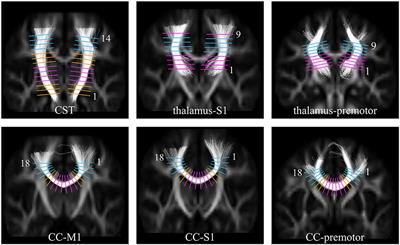 Motor Abilities in Adolescents Born Preterm Are Associated With Microstructure of the Corpus Callosum